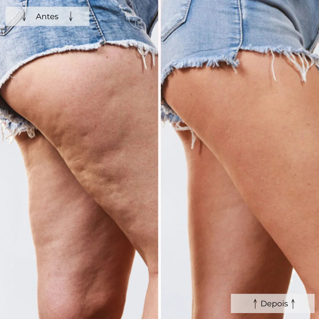 Cellumove Red Light Therapy - Éliminez la cellulite en 28 jours